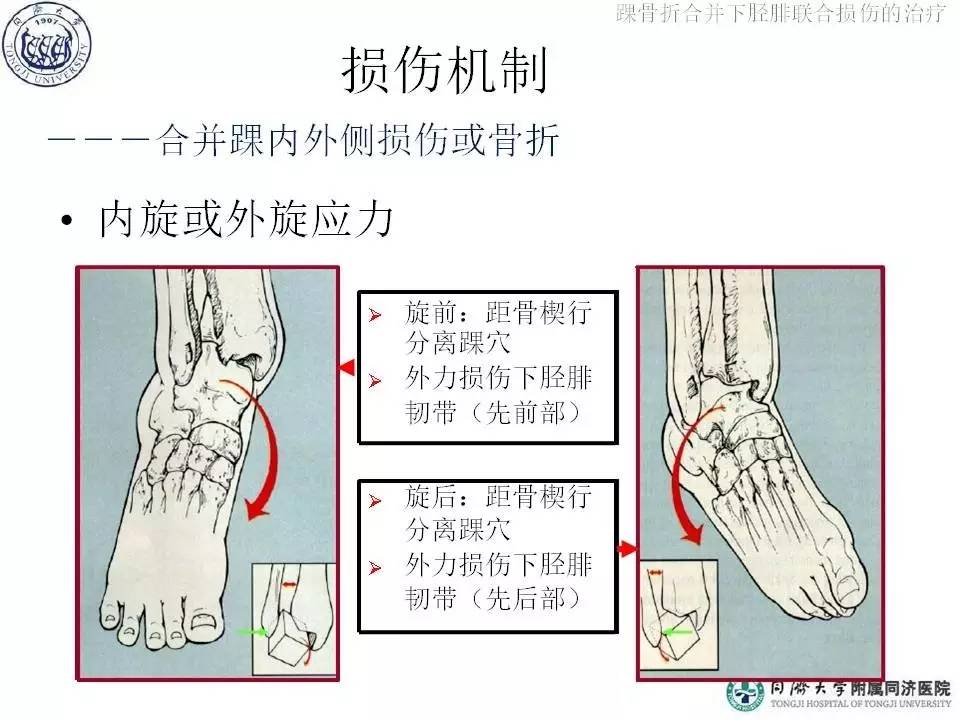 过度背屈旋前力量使较宽的距骨前部楔形分离踝穴 前韧带,骨间韧带及后