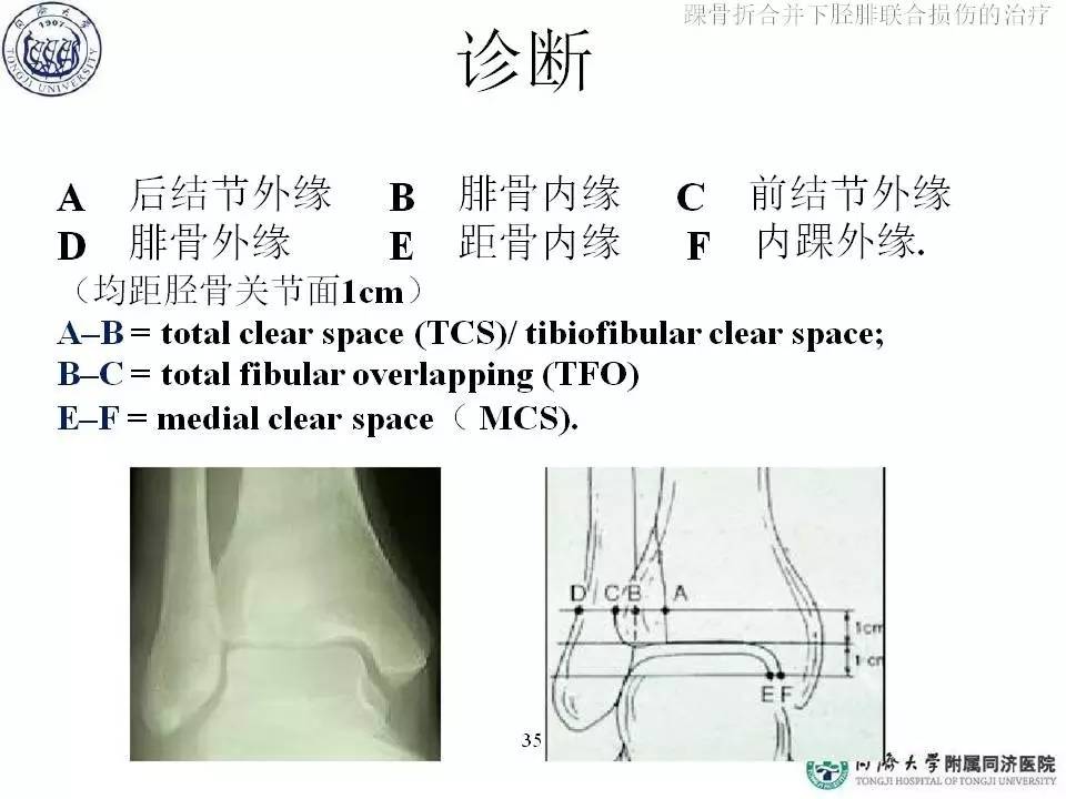 触诊:压痛点 活动度:主动被动外旋活动时疼痛 cotton 试验 :与健侧