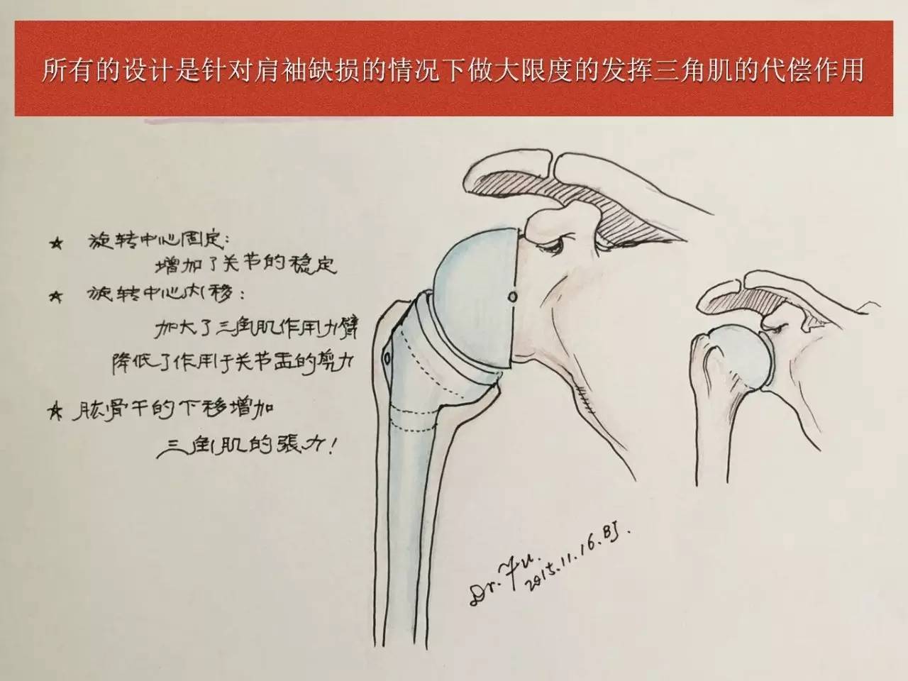 付中国肩关节反向假体置换术技巧