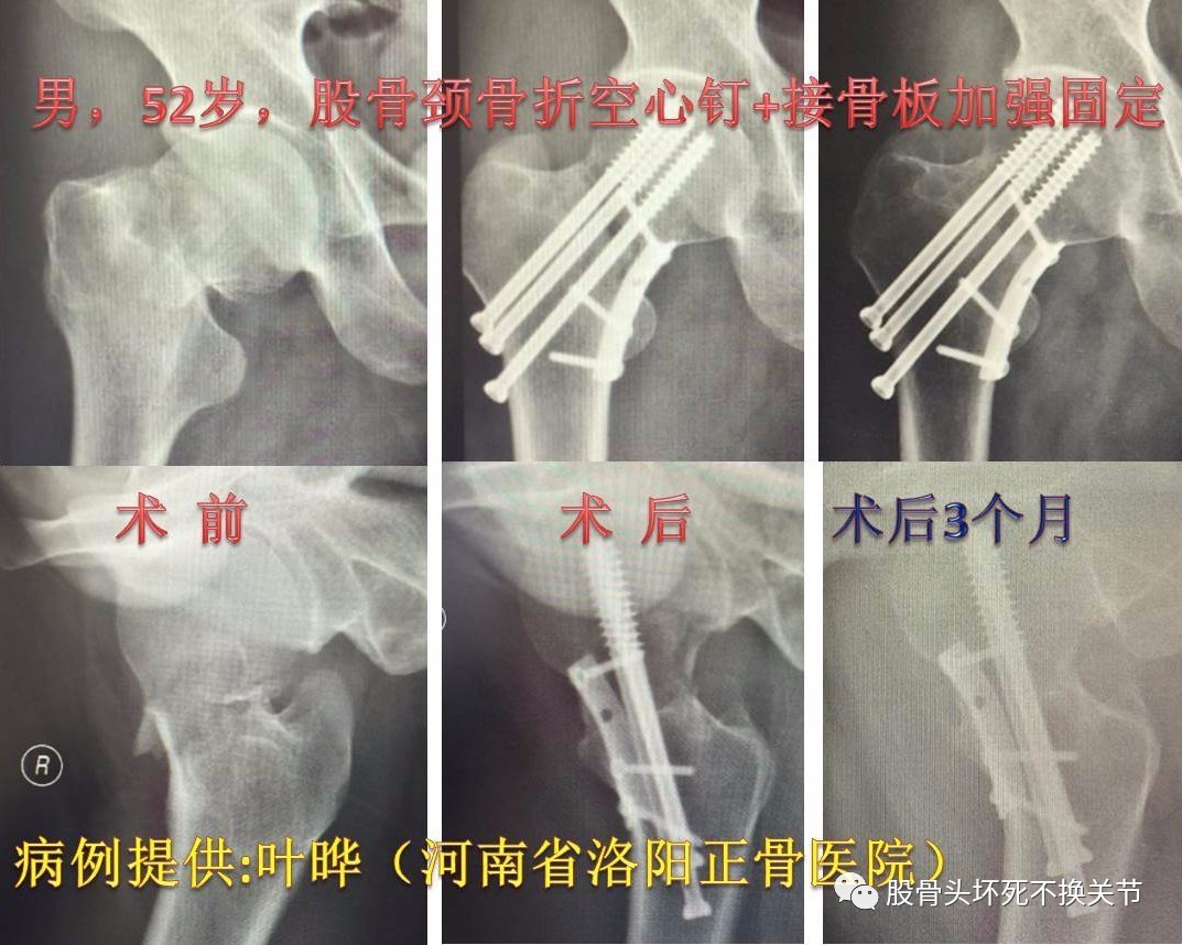 股骨颈骨折注定要人工关节置换?