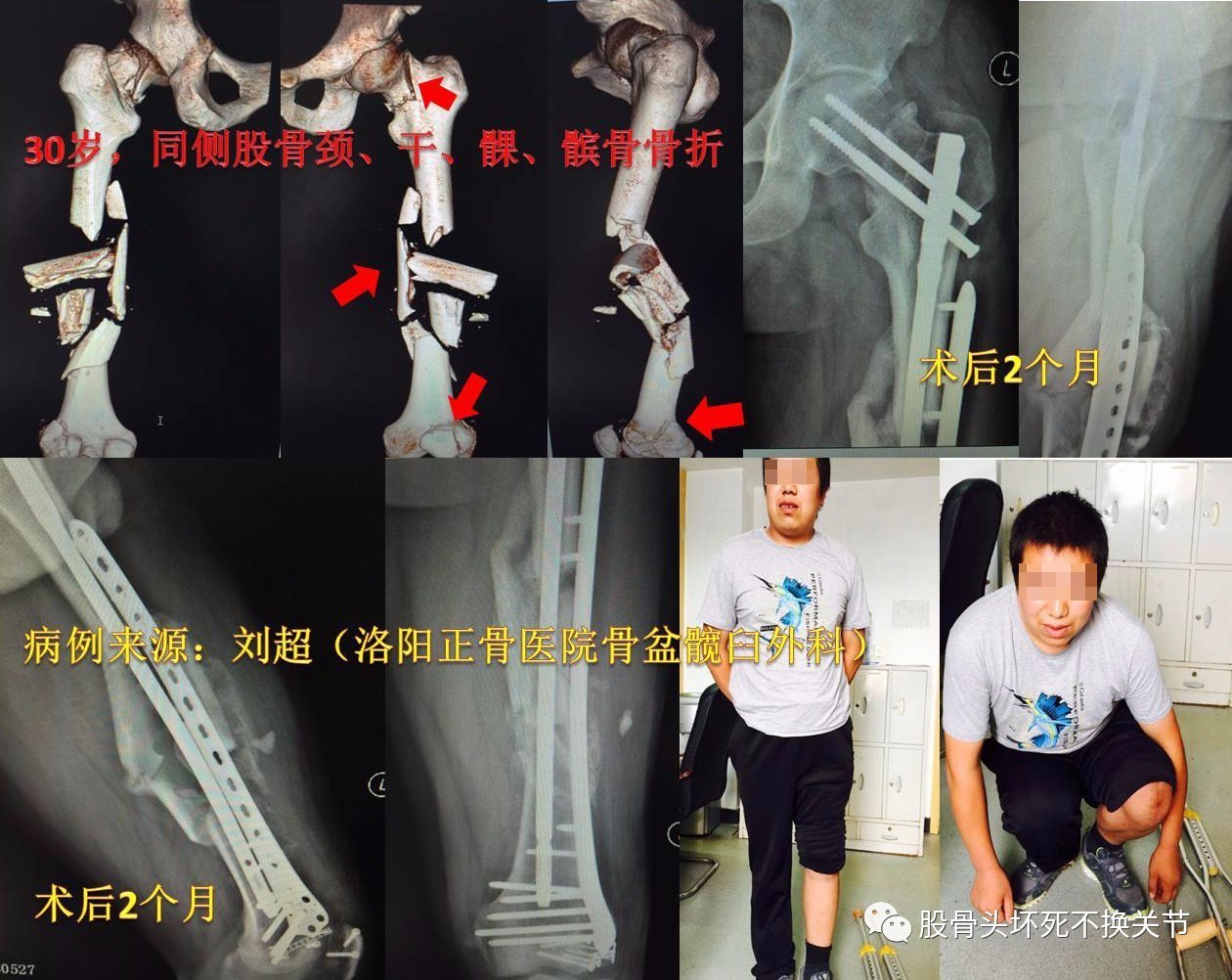 股骨颈骨折注定要人工关节置换?