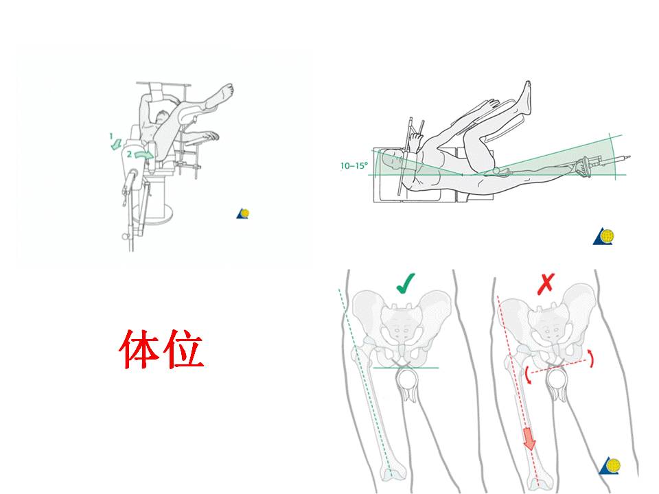 牵引达到颈干角合适位置;内旋使得髌骨朝天,若髌骨畸形,拍摄股骨髁侧