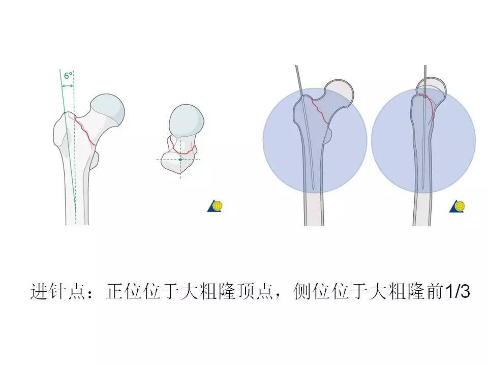 牵引达到颈干角合适位置;内旋使得髌骨朝天,若髌骨畸形,拍摄股骨髁侧