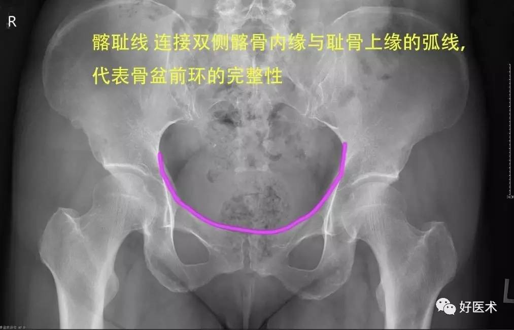 髂耻线 连接双侧髂骨内缘与耻骨上缘的弧线,代表骨盆前环的完整性.e.
