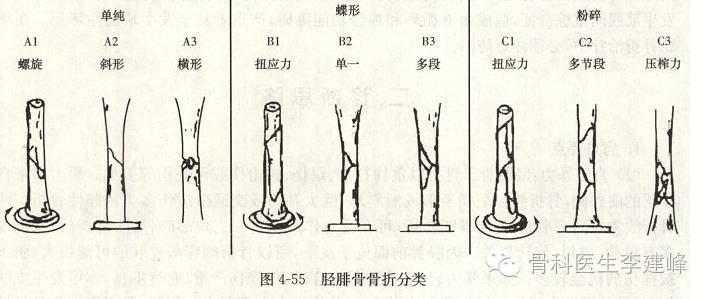 胫腓骨骨折的治疗方法