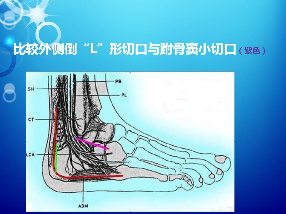 跗骨窦切口治疗跟骨骨折