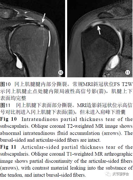 肩关节常见病变:mri诊断