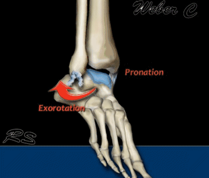 型损伤示意图:踝关节骨折分型:踝关节的环形稳定结构:踝关节分为内踝