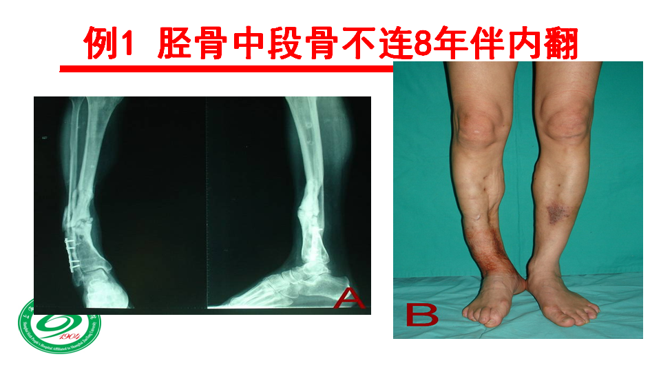 持续缓慢牵张治疗肥大性骨不连