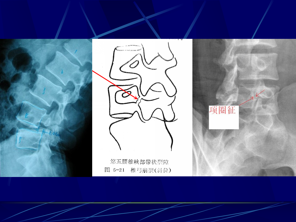 腰椎的影像解剖以及常见病变