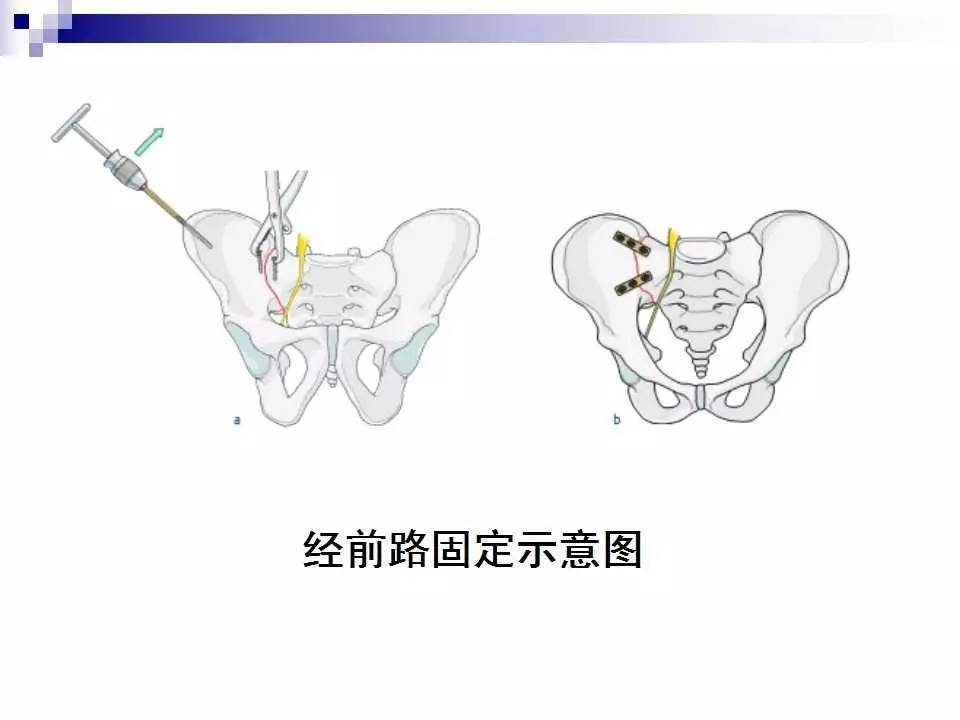 骨盆骨折的分类及治疗