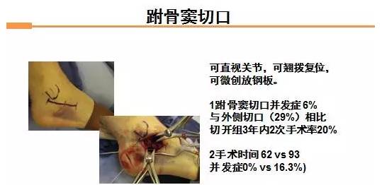 跗骨窦切口以小切口直视关节,有效减少手术时间与并发症