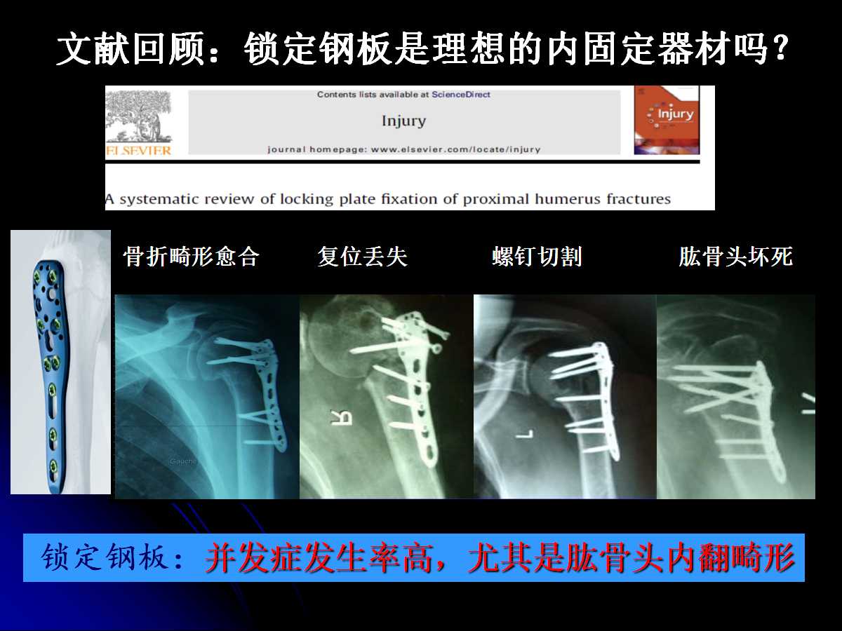 一篇课件读懂髓内钉治疗肱骨近端骨折
