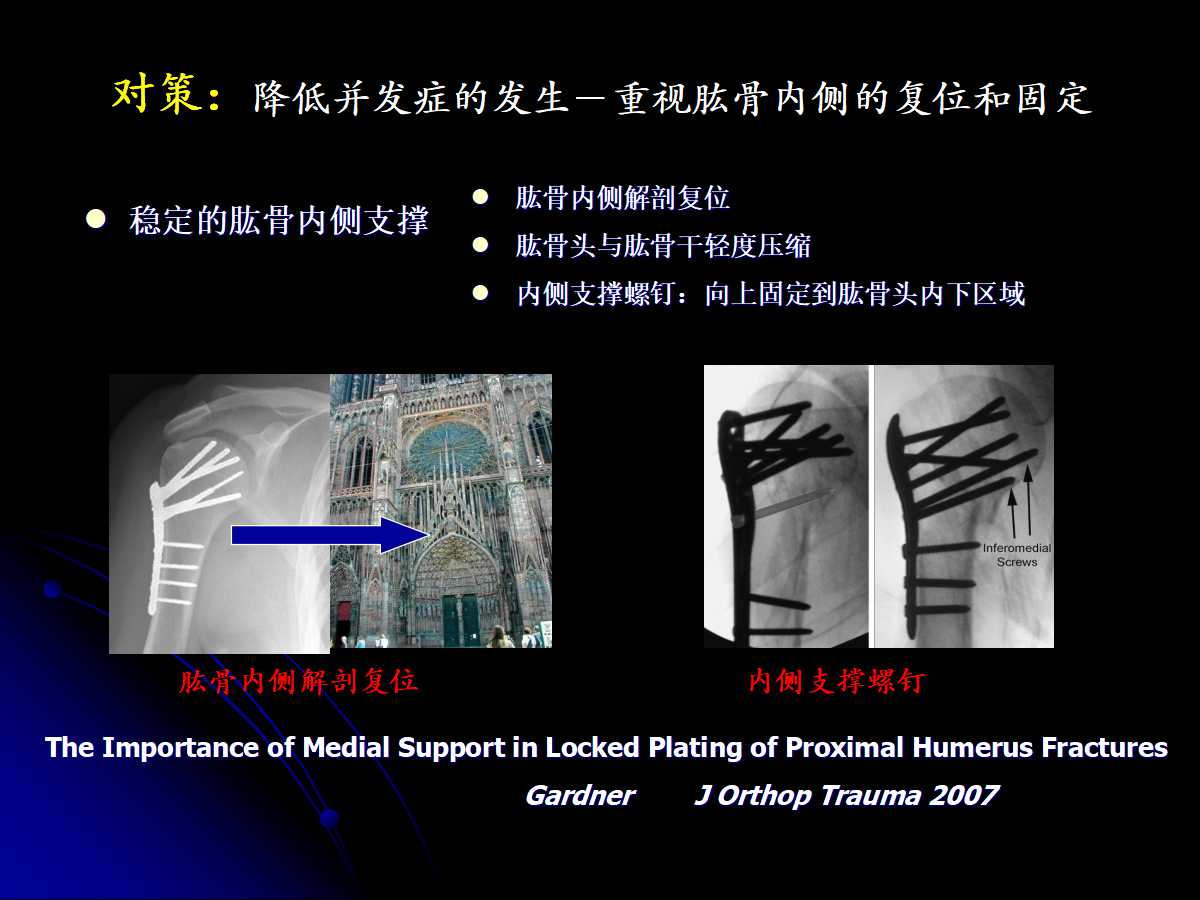 一篇课件读懂髓内钉治疗肱骨近端骨折