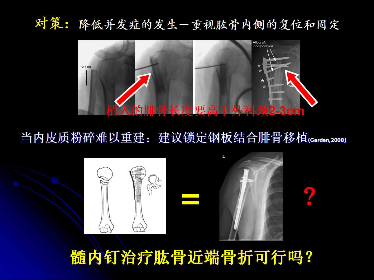 一篇课件读懂髓内钉治疗肱骨近端骨折