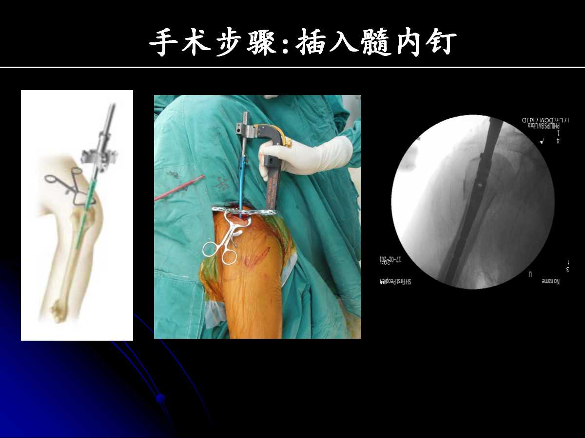 一篇课件读懂髓内钉治疗肱骨近端骨折