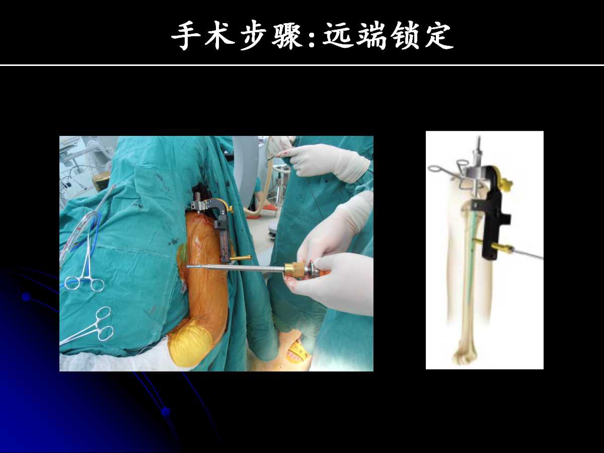 一篇课件读懂髓内钉治疗肱骨近端骨折