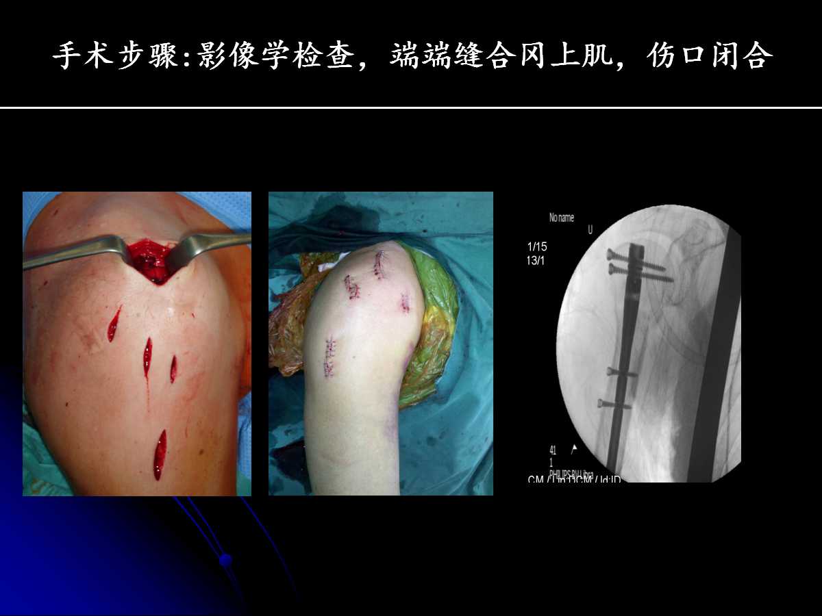 一篇课件读懂髓内钉治疗肱骨近端骨折