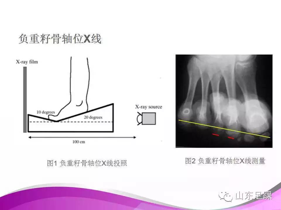 拇外翻x线测量评估及术式选择