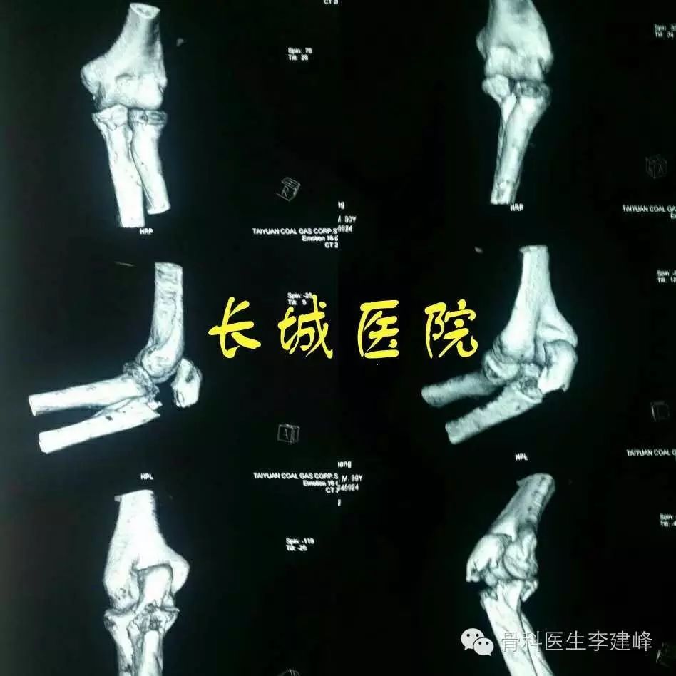 受伤后肘关节ct重建