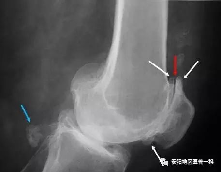 长骨刺了怎么办?