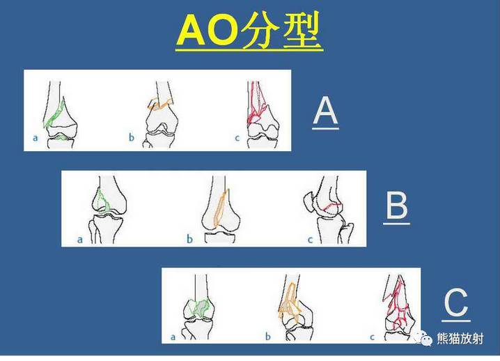 内收型:pauwels角>50度,为极不稳定型 b3型:冠状面骨折,包括①前及外