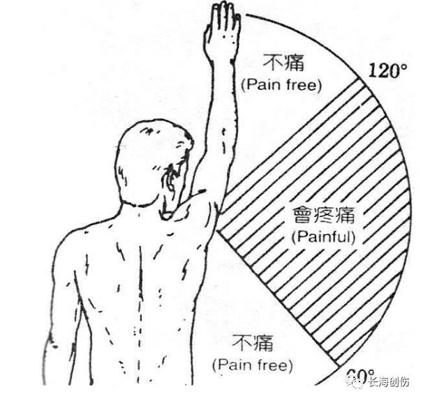 5,疼痛弧和垂臂试验阳性 肢外展上举60～120°范围时由于肩袖受到的