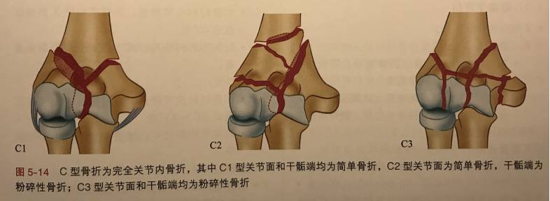 肱骨远端骨折的临床诊治要点