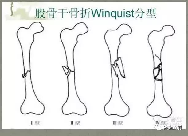 收藏| 四肢骨折分型大全