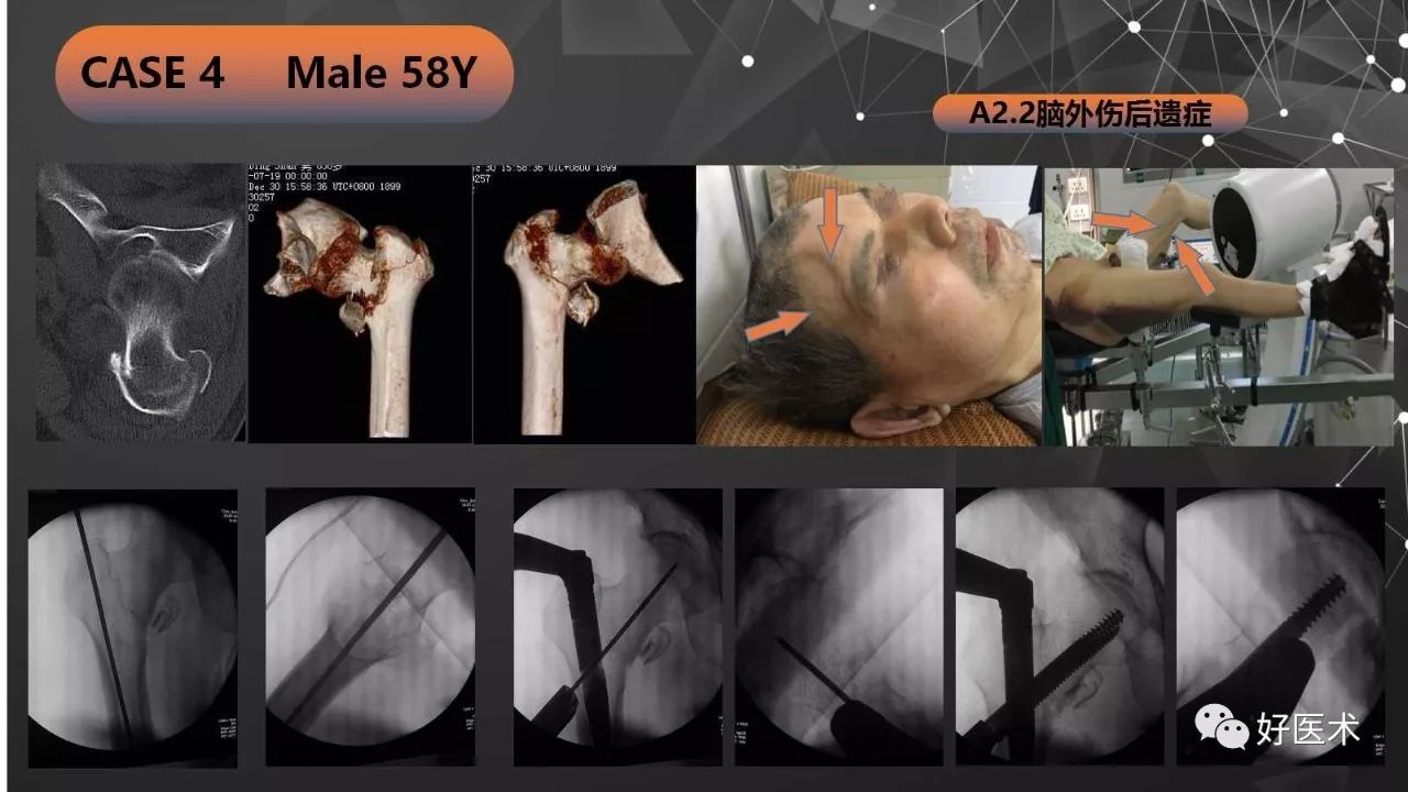 intertan在股骨粗隆间骨折的应用及技术要点