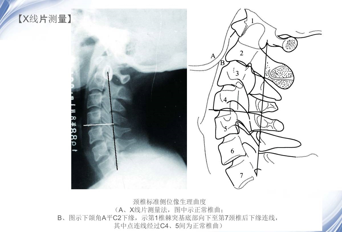 颈椎x线诊断的内容及其解读