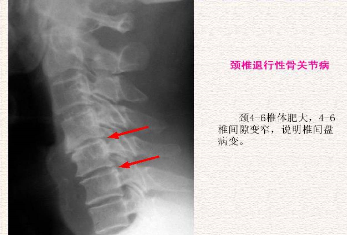 颈椎x线诊断的内容及其解读