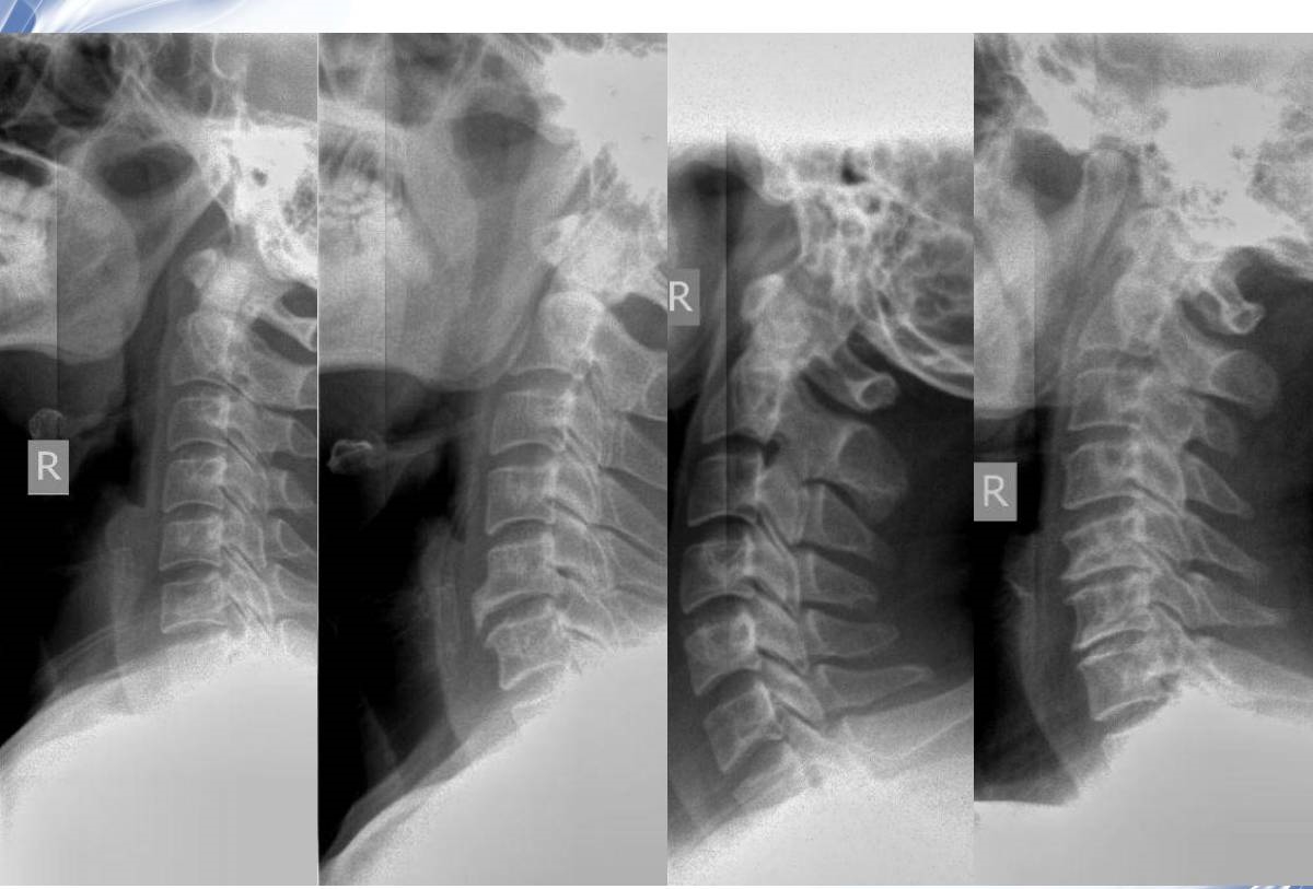颈椎x线诊断的内容及其解读