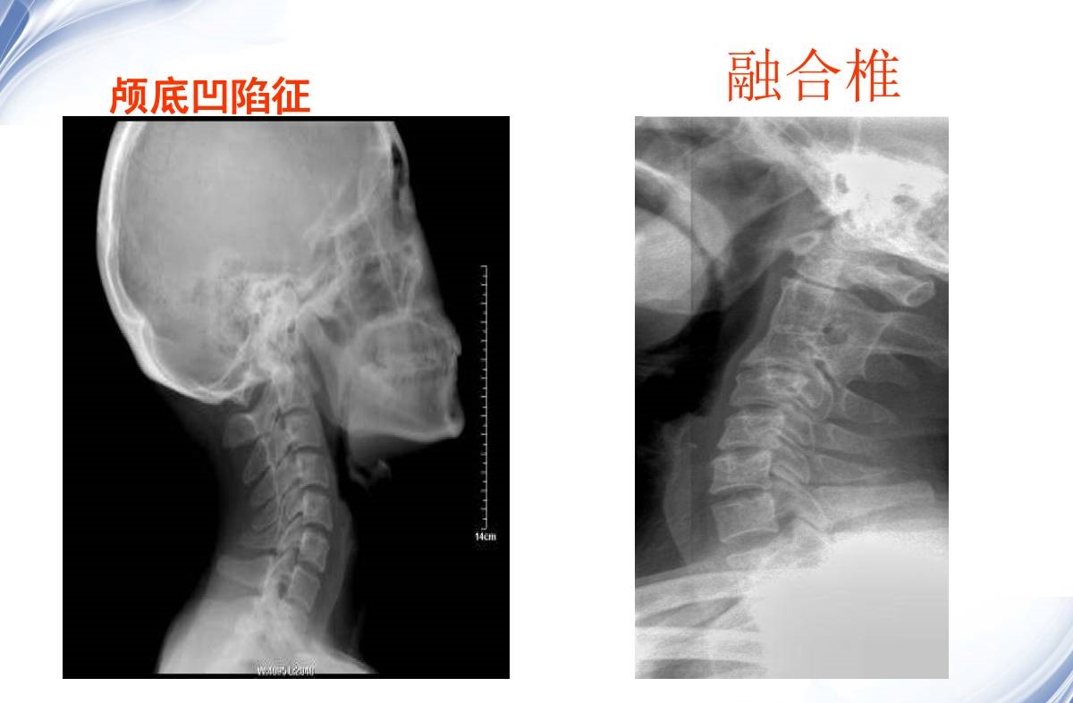 颈椎x线诊断的内容及其解读