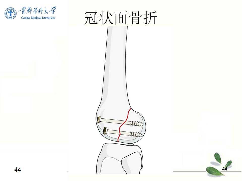 股骨远端骨折的复位技巧及要点