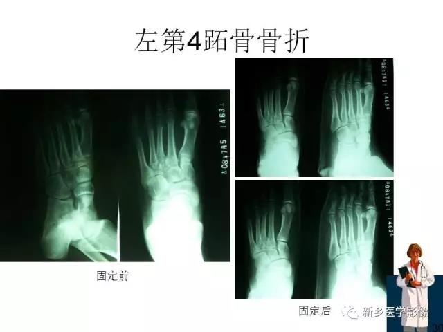 全身常见骨折x线汇总