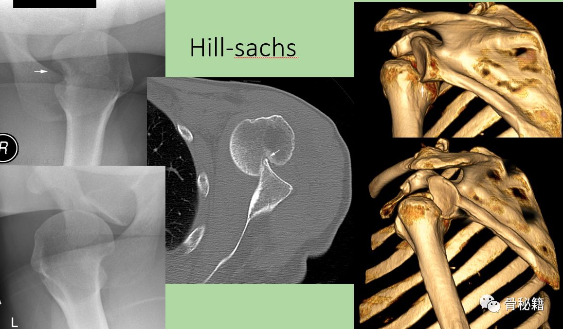 hill-sachs 损伤的诊断及治疗要点