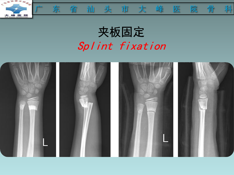 桡骨远端骨折的分型及治疗策略