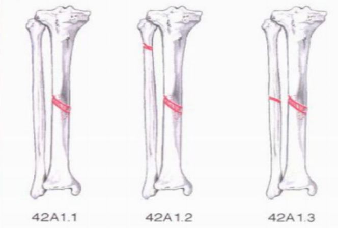 常见四肢骨折分型汇总,快快收藏吧!