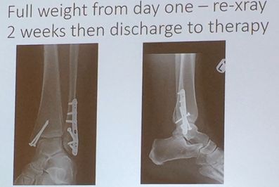 aaos 2018:踝关节骨折后到底什么时候负重?