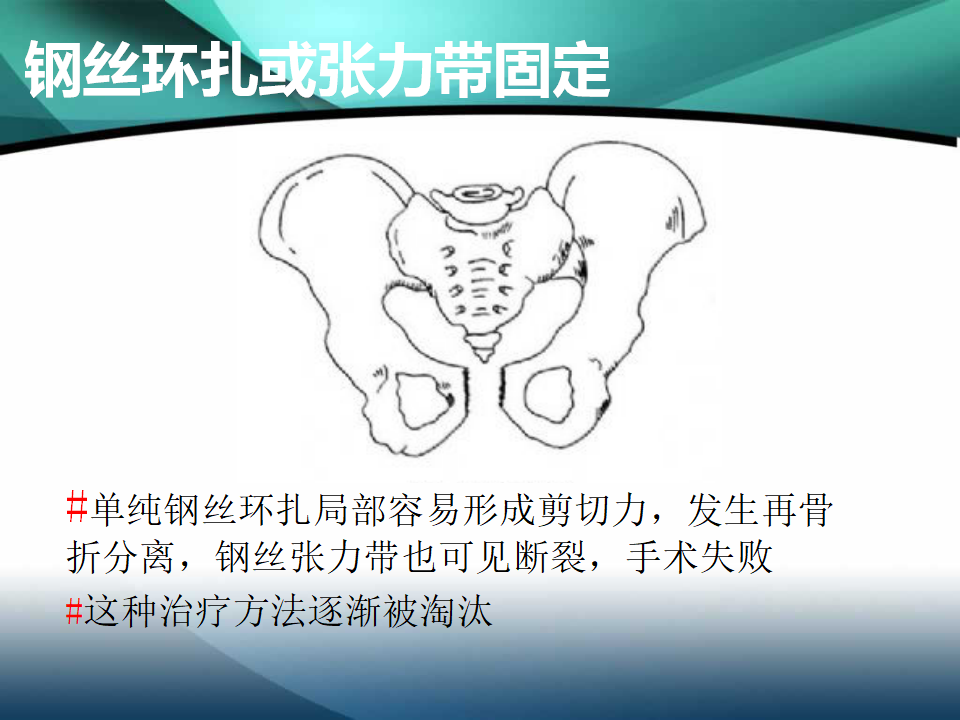 耻骨联合分离的诊断及治疗策略