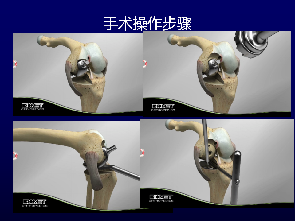 单髁置换术治疗膝关节骨性关节炎