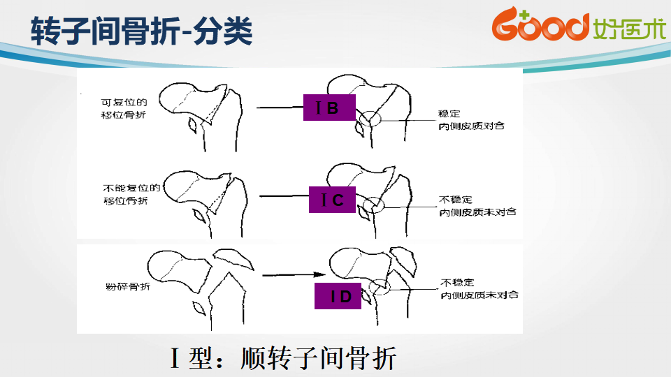 股骨转子间骨折的治疗方法及手术技巧