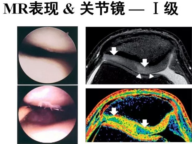 一篇掌握:髌骨软化症的影像学诊断!