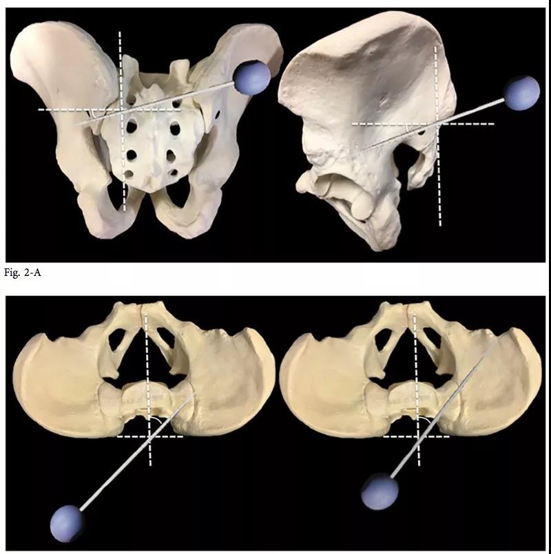 s2骶髂螺钉的徒手置入技术,详细讲解!