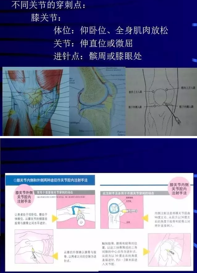 各关节腔穿刺方法技巧大全,太详细了!