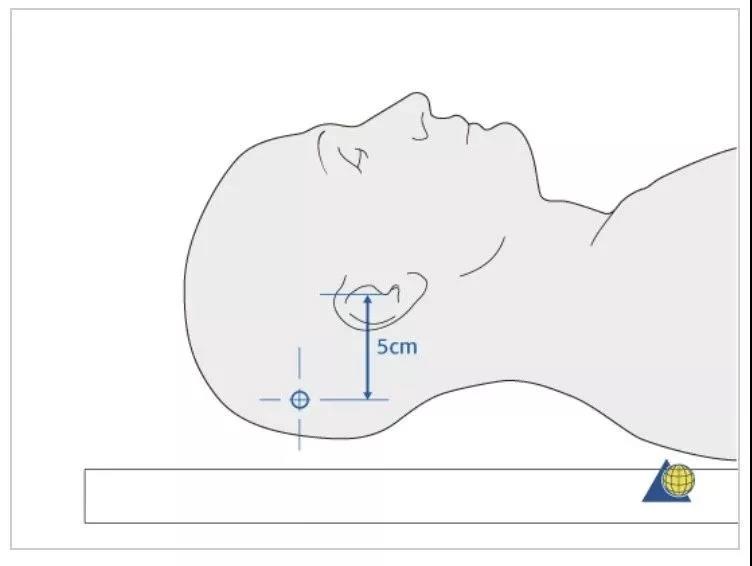 头环后方钉进针点位于耳尖后方5cm.