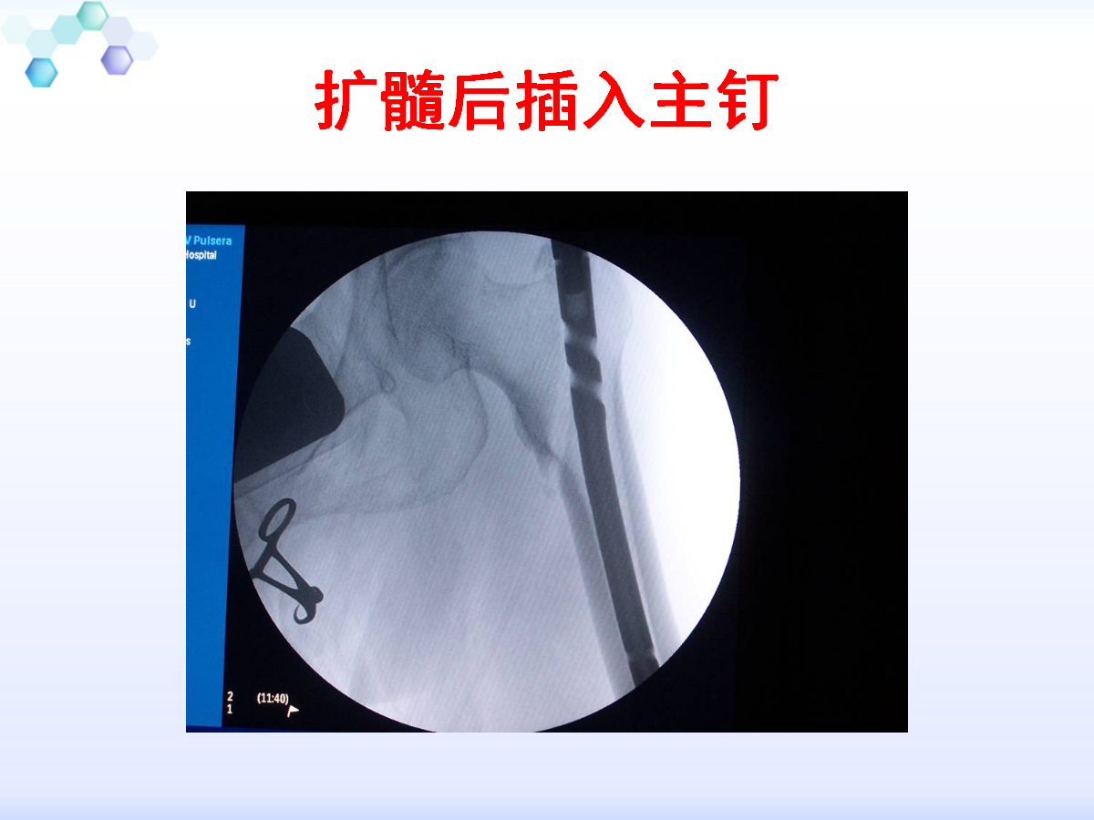 侧卧位置入髓内钉治疗粗隆周围骨折,技巧详解!