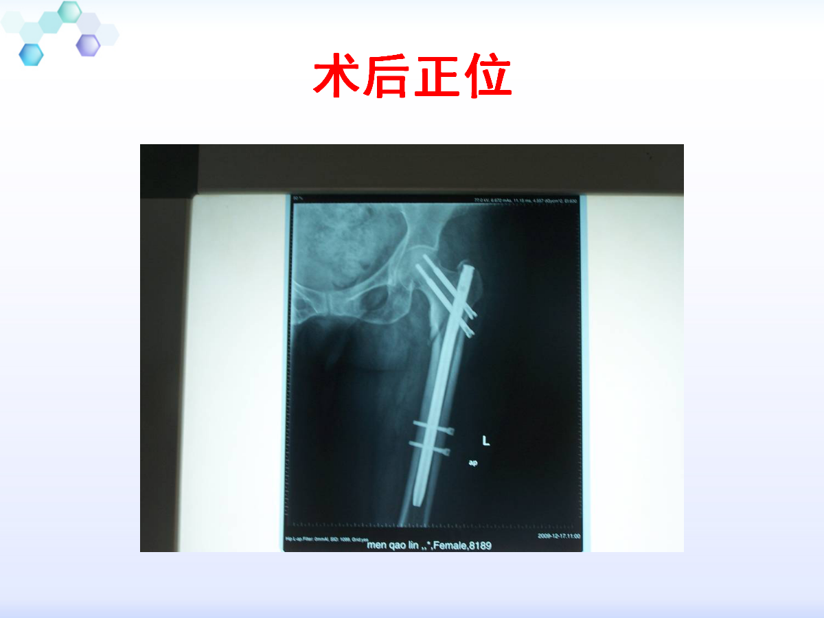 侧卧位置入髓内钉治疗粗隆周围骨折,技巧详解!