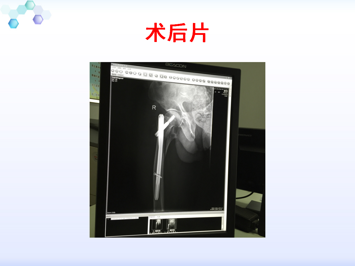 侧卧位置入髓内钉治疗粗隆周围骨折,技巧详解!